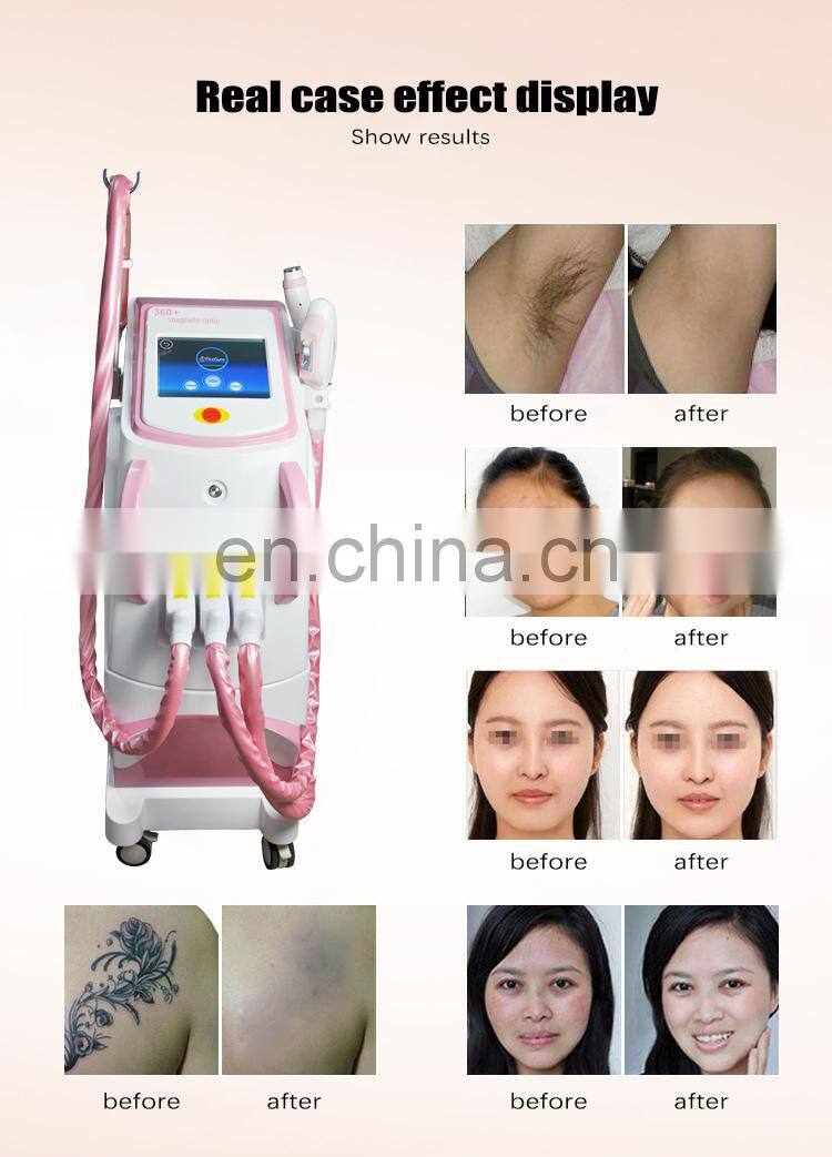 Laser picosecond q switched nd yag opt rf pico laser cleaning 3 in 1 multifunctional beauty machine