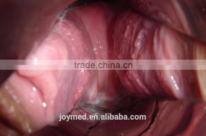 Digital Video Colposcope, Laptop Video Colposcope, Gynecology Video Colposcope