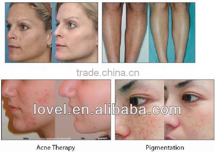 Vertical Hair Removal, Wrinke Removal ipl shr laser Beauty Device with Medical CE