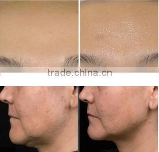 Facial resurfacing acne scar removal treatment fractional rf