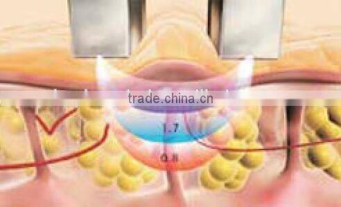 face body wrinkle removal multi-channel RF key-330 machine