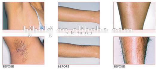 2014 new speediness professional e light ipl rf nd yag laser 4 in 1