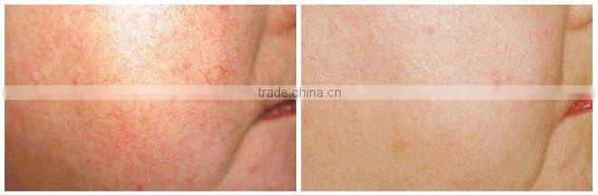 E-light Laser Hair Removal Machine for Sale