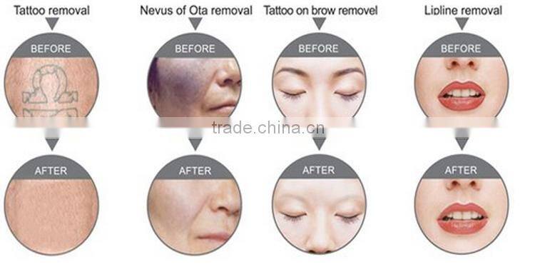professional q switched long plused ng yag laser tattoo removal machines