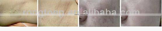 ipl/rf hair removal machine