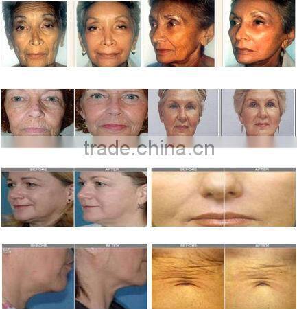 rf skin firming machine