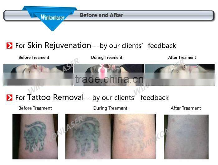 Factory supply home nd yag laser/ tattoo removal treatment