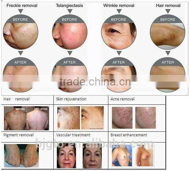 2014 Hot sale Vertical E-light(IPL+RF) beauty machine for hair removal and skin care