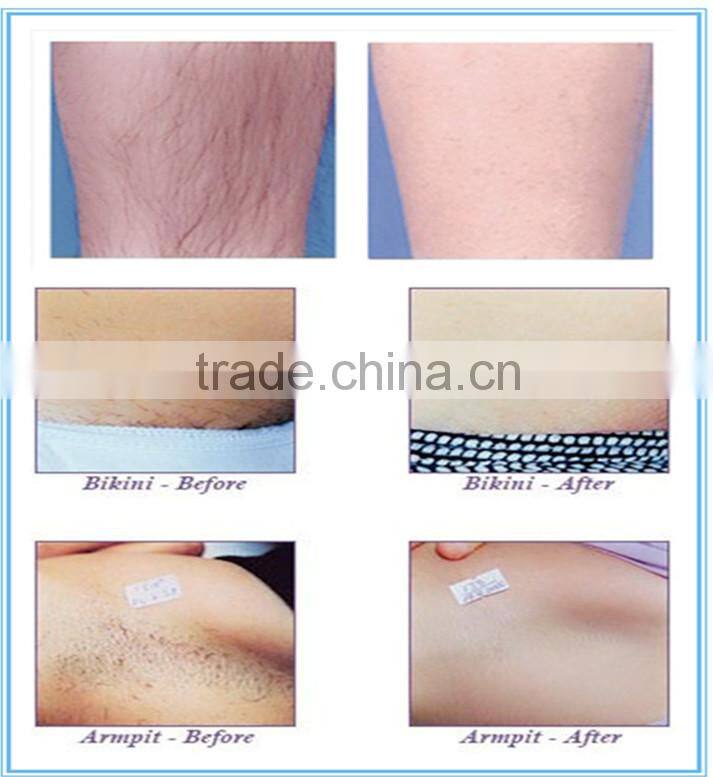 hot selling products hair removal ipl