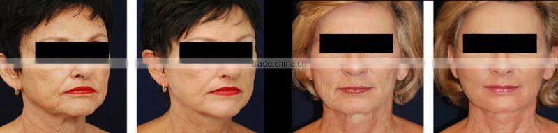 best portable ultrasonic cavitation machine price/ultrasonic cavitation device