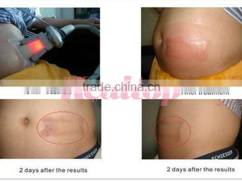 Newest model cryo-lipolysis cryotherapy freezing fat removal cellulite machine!weight loss lipo cryo machine on sale promotion