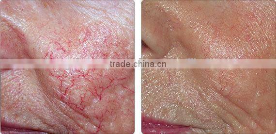 Removal facial thread veins with RBS machine