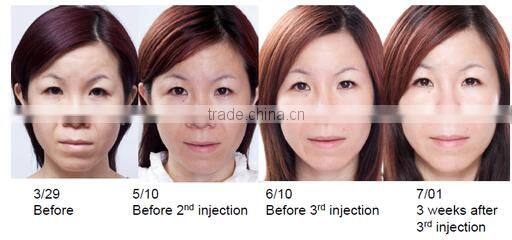 Merry christmas present !portable hifu rf wrinkle removal skin tightening machine for home use