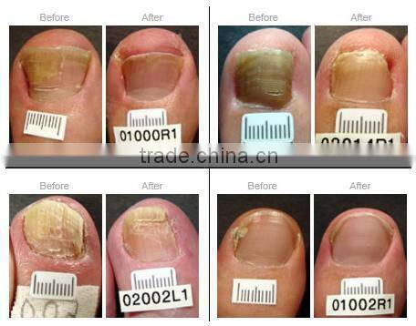 long pulse nd yag laser with skin contact cooling system P-C01