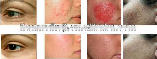 2016 Newest vertical salon use co2 fractional laser beauty equipment