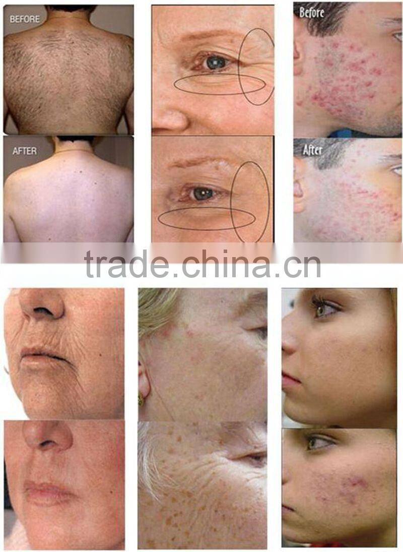 Most effective hair removal &skin rejuvenation machine hair depilate