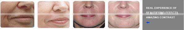 Effective Bio-light therapy!!!! high quality skin rejuvenation ipl/rf/e light/led/pdt/laser