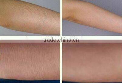 2015 newest salon use mini shr IPL intense pulse light hair removal machine