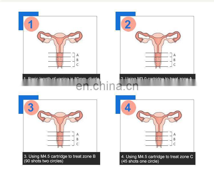360 degree hifu vaginal tightening device/vaginal tightening machine price