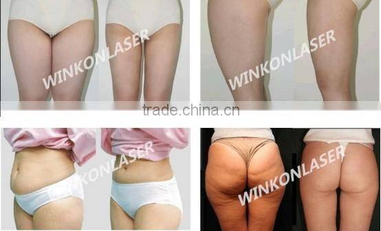 shape cellulite removal machine / cellulite deep heat therapy / anti cellulite machine