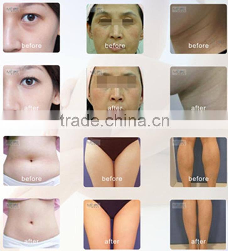 China manufacturer cavitation rf vacuum body slimming machine