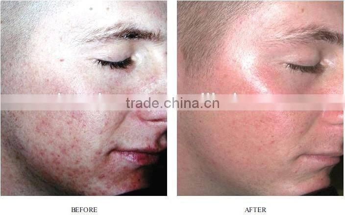 Vertical Multifunctional SHR hair removal machine