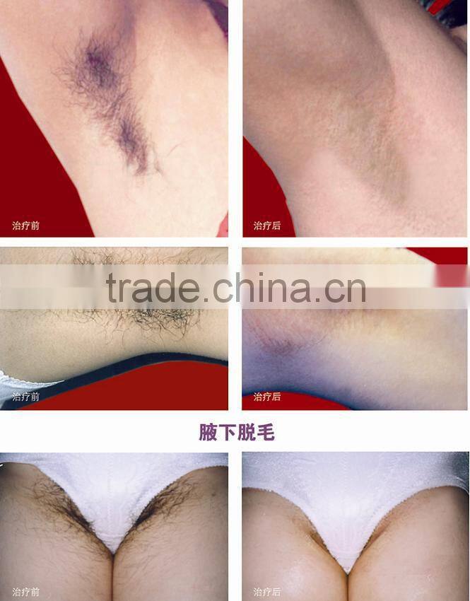 Most Advanced SHR IPL Technology e-light+ipl+shr for beauty salon