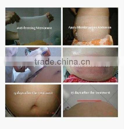 Medical CE approved Cryo anti cellulite massager