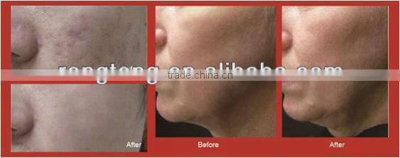 water oxygen Jet facial cleaning beauty equipment