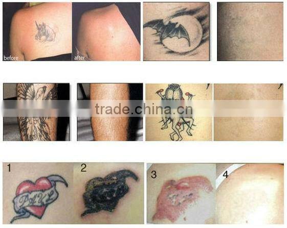 New Design Tattoo Removal Machine Looking for Exclusive Distributors Q Switched Nd YAG Laser/Laser Machine for Tattoo Removal