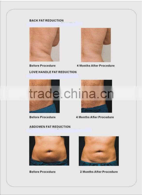 Weight Loss ,easy operation Feature and portable,Vacuum Cavitation System Type coldlipolysis machine