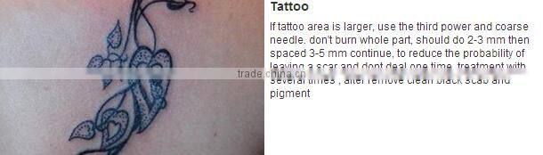 Plasma pen removal tattoo skin pen treatment tattoo removal pen