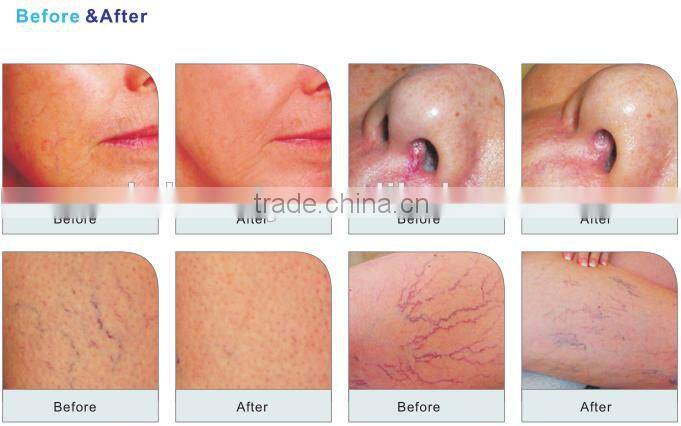 980nm diode laser Cosmetology Machine Vascular Removal Laser Machine