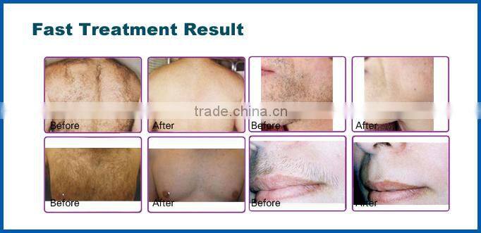 Portable newest medical diode laser 808nm/laser permanent hair removal beauty machine