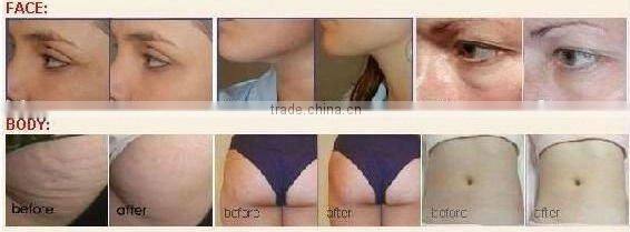 Best slimming machine Ultrasonic body shaping Equipment