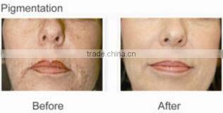Q switch nd yag laser skin age spot removal machine