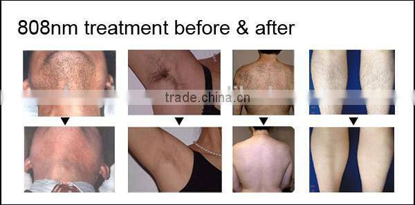 lightsheer diode laser hair removal medical equipment