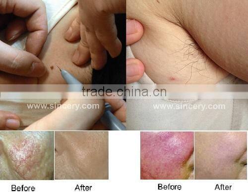 portable spider vein elimination machine for sale