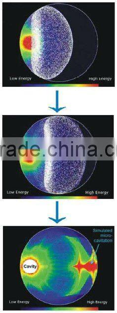 HIFU vrf rf cellulite loss treatment