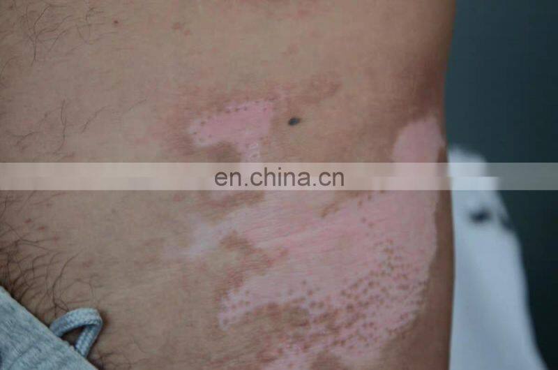 308 nm excimer laser machine fototerapia dermatologia any new puva treatment psoriasis vitiligo light system india price