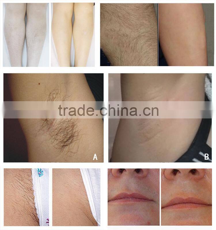 Soft light laser hair removal diode laser 808nm with CE approved