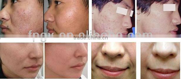 New style hot selling skin care new beauty equipment