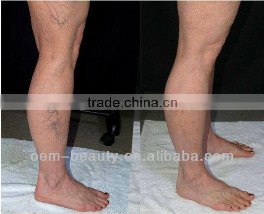 laser depilator long pulse laser permanent hair removal beauty equipment