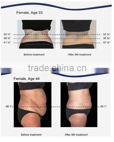 Powerful Body Shaping Weight Loss Machine 650nm Lipo diode laser CS06