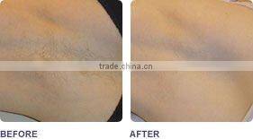 No no hair removal!!!E-light facial hair removal machine for women