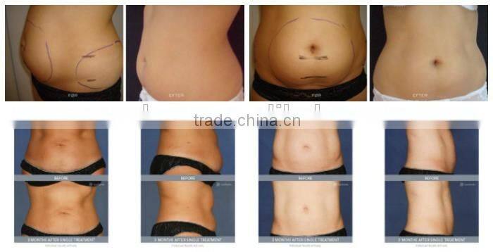 FDA med HIFU weight loss device weight loss