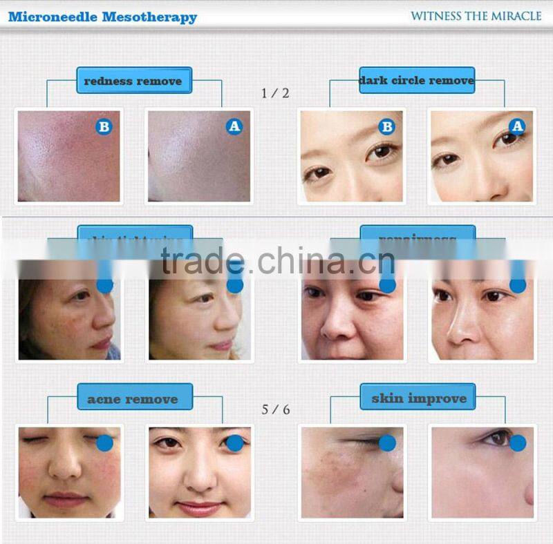 New Year Sale!! Micro Needle Skin Care System 0.20 mm Roller Bio Derma Roller