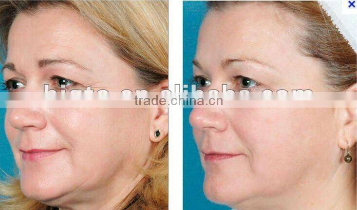 2015 newly-launched portable cavitation+RF slimming machine weight loss machine