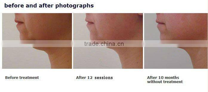 Professional RF Skin Treatment Cavitation Liposuction