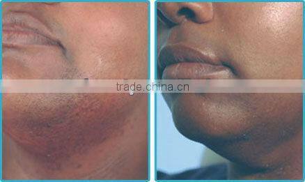 P001 Dark Skin Laser Hair Removal Long Pulse Laser with Two Treatment Heads